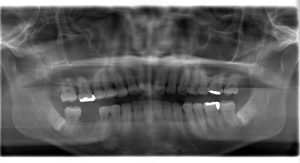 【症例】下顎右側第一大臼歯の欠損に対してインプラント治療を行った症例