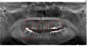 【症例】前歯のぐらつきを主訴に来院された患者様に対してインプラントを交えた全顎治療を提案した症例