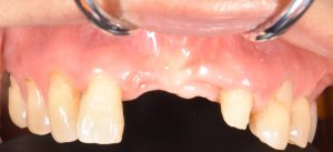 【症例】前歯部に対してインプラント治療を見据えてGBR(骨造成法)を行った一症例