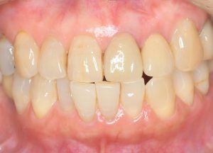【症例】審美領域に対して抜歯即時インプラント埋入即時荷重を行い、上部構造を装着した一症例