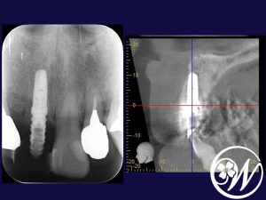 【症例】50代女性「前歯が折れてしまった」根っこまで割れていた歯を抜いた後、すぐにインプラントを埋入した症例