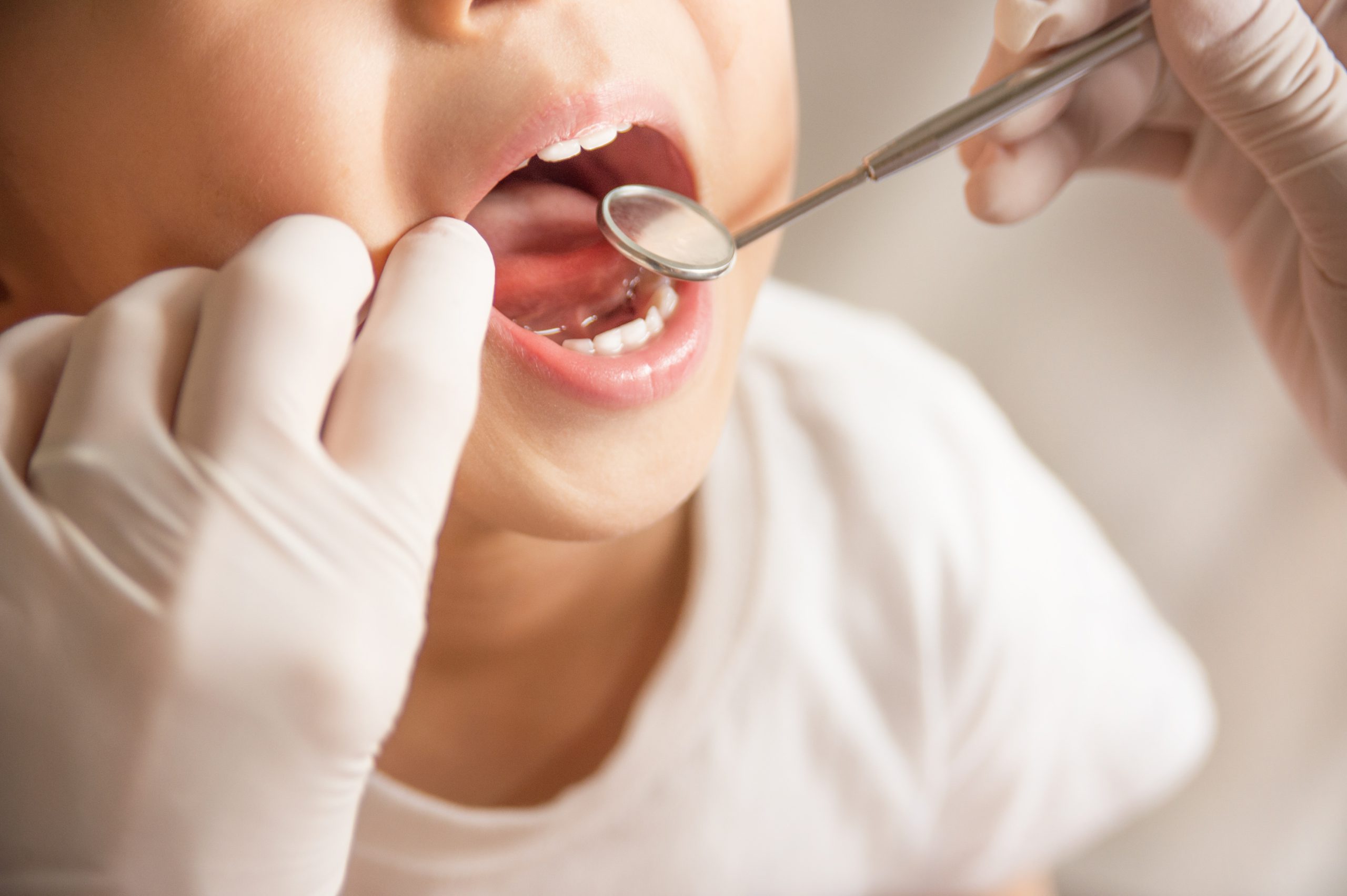 虫歯になりやすい子供の特徴と原因とは？自宅と小児歯科でできる予防方法を分かりやすく解説！