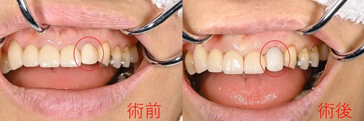【症例】仮歯の装着を即日行える「抜歯即時インプラント埋入処置」による前歯のインプラント治療