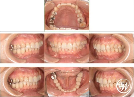 【症例】50代男性　インプラントと被せ物で治療