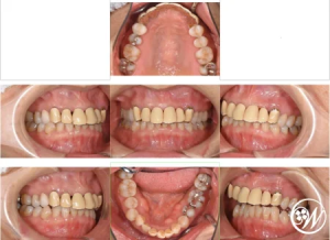 【症例】ジルコニアの被せ物と針金のない見た目が美しい入れ歯治療