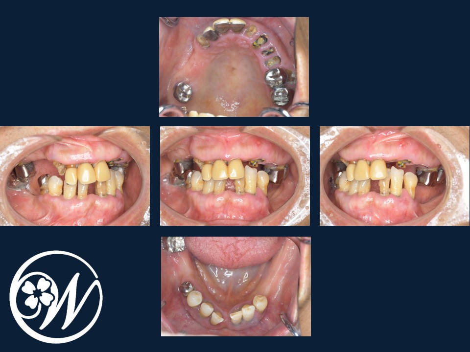 【症例】歯がほとんどないお口をインプラント治療で機能的・審美的に改善し、QOLが大きく向上|インプラント治療前の歯①｜千葉県柏市の歯医者「ウィズ歯科クリニック」