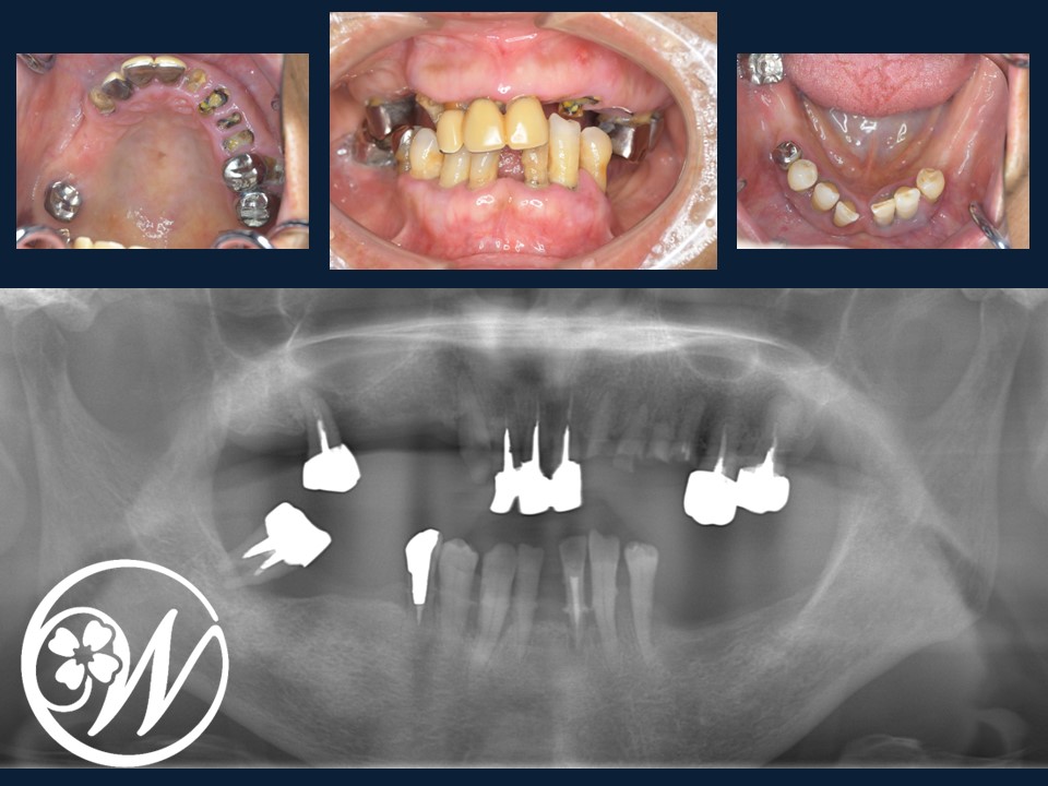 【症例】歯がほとんどないお口をインプラント治療で機能的・審美的に改善し、QOLが大きく向上|インプラント治療前の歯②｜千葉県柏市の歯医者「ウィズ歯科クリニック」