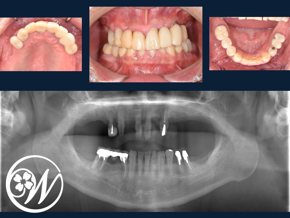 【症例】大がかりな手術をしないインプラント治療で、ボロボロ・ガタガタ・グラグラの歯を美しく回復|インプラント治療前の歯｜千葉県柏市の歯医者「ウィズ歯科クリニック」