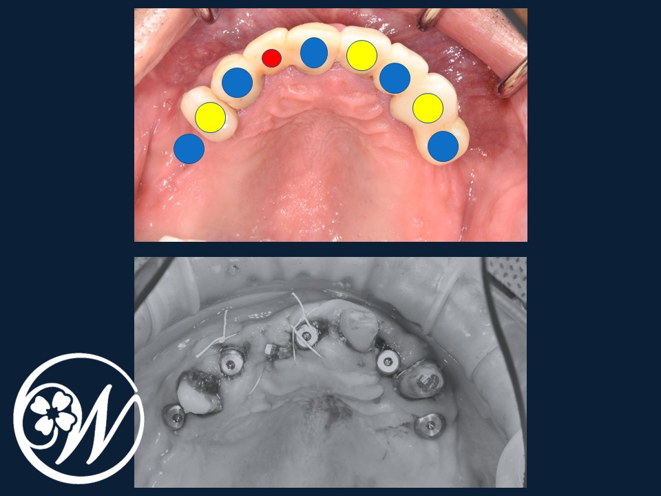【症例】大がかりな手術をしないインプラント治療で、ボロボロ・ガタガタ・グラグラの歯を美しく回復|インプラント治療中の歯①｜千葉県柏市の歯医者「ウィズ歯科クリニック」