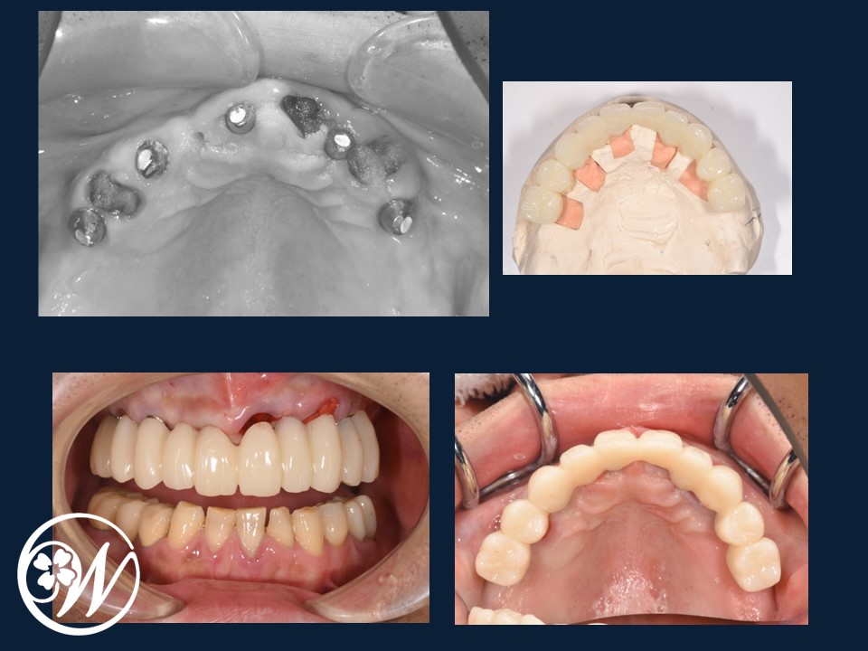 【症例】大がかりな手術をしないインプラント治療で、ボロボロ・ガタガタ・グラグラの歯を美しく回復|インプラント治療中の歯②｜千葉県柏市の歯医者「ウィズ歯科クリニック」