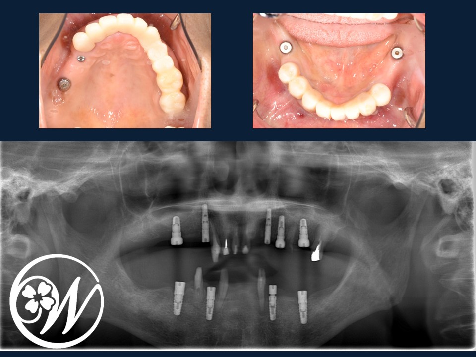 【症例】歯がほとんどないお口をインプラント治療で機能的・審美的に改善し、QOLが大きく向上|インプラント治療中①｜千葉県柏市の歯医者「ウィズ歯科クリニック」