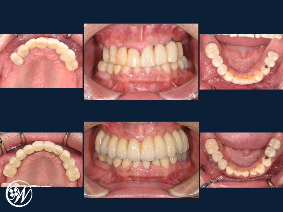 【症例】大がかりな手術をしないインプラント治療で、ボロボロ・ガタガタ・グラグラの歯を美しく回復