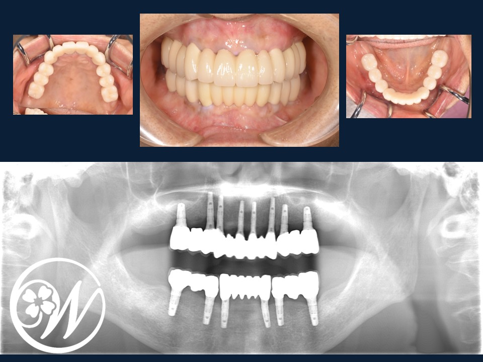 【症例】歯がほとんどないお口をインプラント治療で機能的・審美的に改善し、QOLが大きく向上|インプラント治療後の歯｜千葉県柏市の歯医者「ウィズ歯科クリニック」