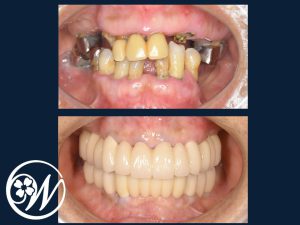 【症例】歯がほとんどないお口をインプラント治療で機能的・審美的に改善し、QOLが大きく向上|インプラント治療前後の歯｜千葉県柏市の歯医者「ウィズ歯科クリニック」