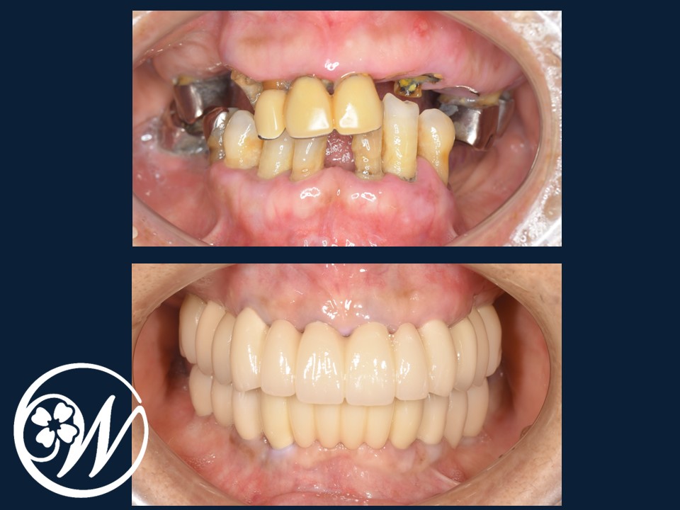 【症例】歯がほとんどないお口をインプラント治療で機能的・審美的に改善し、QOLが大きく向上
