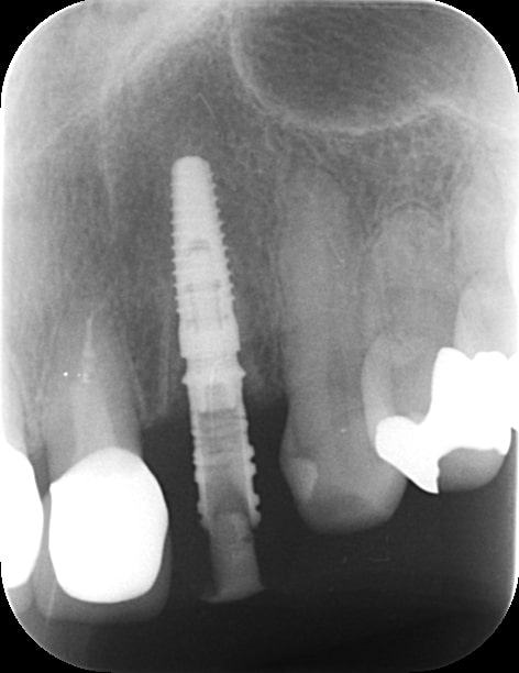 【症例】仮歯の装着を即日行える「抜歯即時インプラント埋入処置」による前歯のインプラント治療｜インプラント治療後のデンタルX線写真｜千葉県柏市の歯医者「ウィズ歯科クリニック」