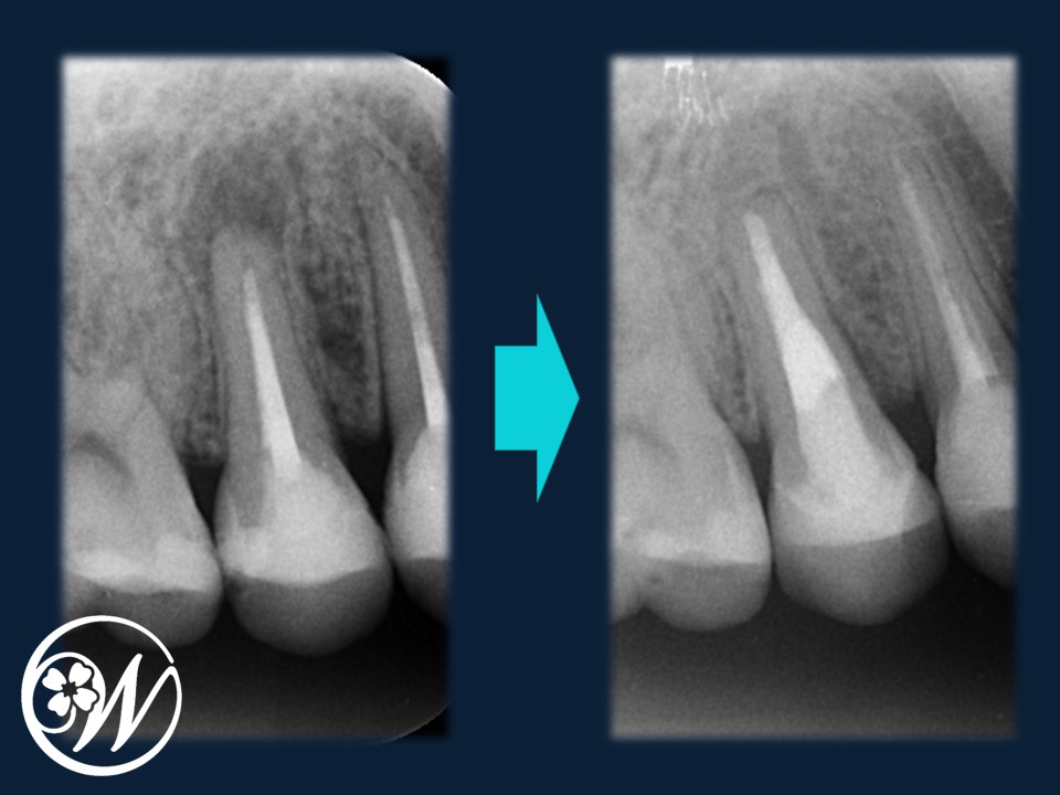 【症例】フラップレスインプラントで「切らない・縫わない」「痛みが少ない・腫れない・出血しない」低侵襲なインプラント治療を実現｜根管治療前後｜千葉県柏市の歯医者「ウィズ歯科クリニック」