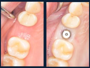 【症例】フラップレスインプラントで「切らない・縫わない」「痛みが少ない・腫れない・出血しない」低侵襲なインプラント治療を実現