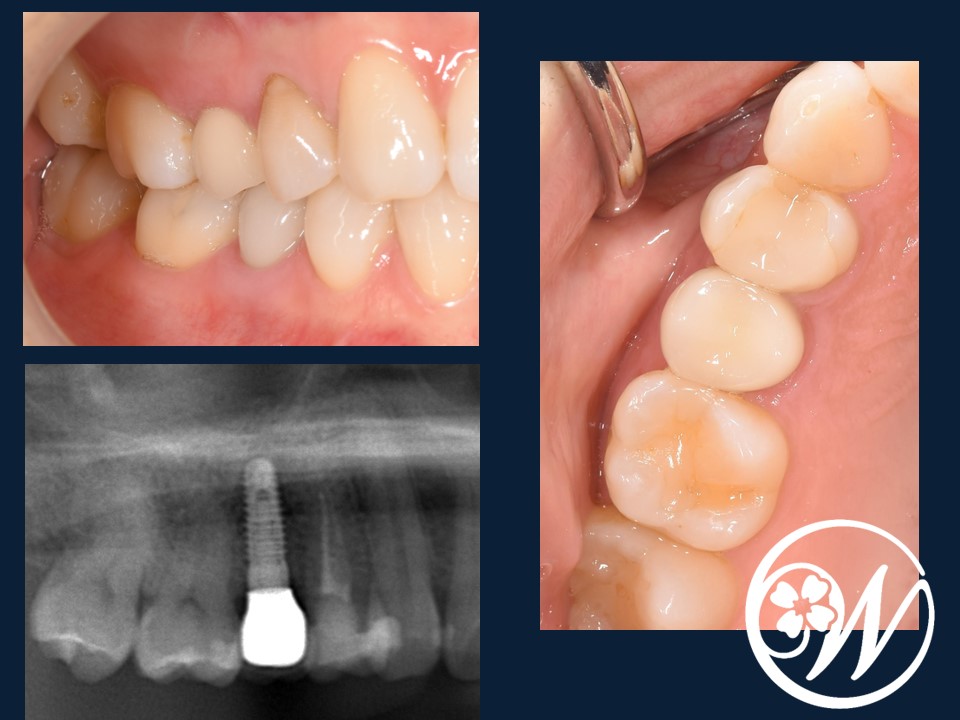【症例】フラップレスインプラントで「切らない・縫わない」「痛みが少ない・腫れない・出血しない」低侵襲なインプラント治療を実現｜補綴物装着後｜千葉県柏市の歯医者「ウィズ歯科クリニック」