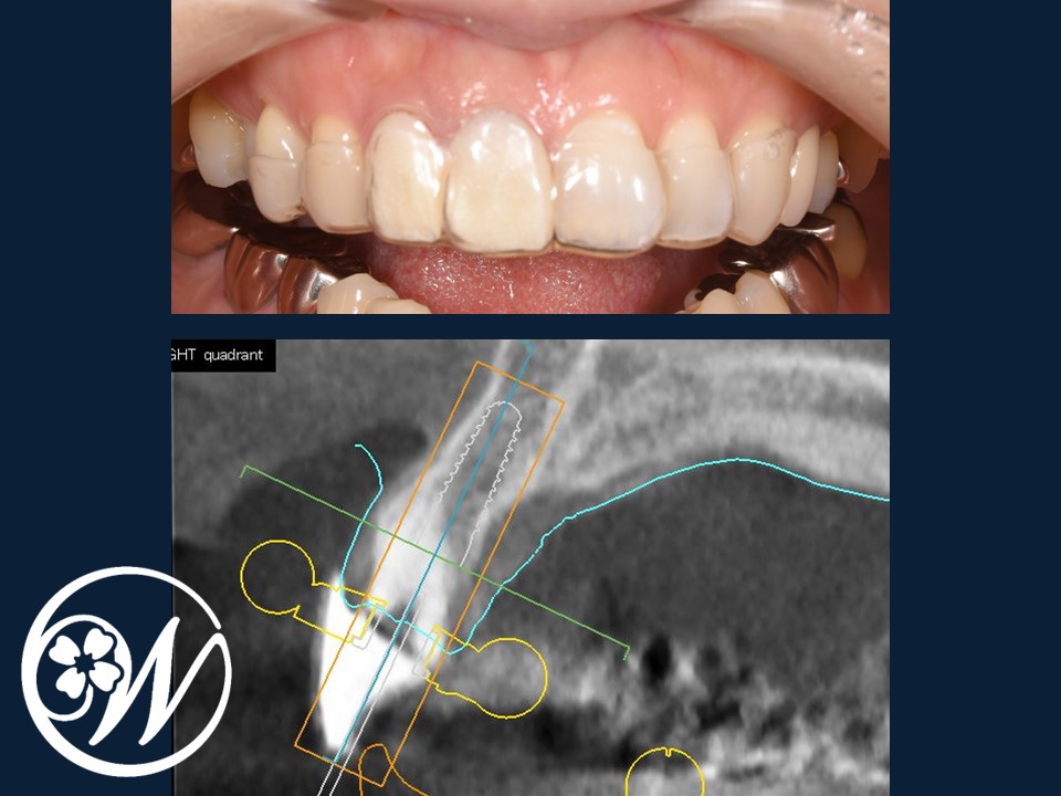 【症例】抜歯即時インプラント埋入治療で不揃いの前歯を1日で美しい見た目に|インプラント治療中の前歯①｜千葉県柏市の歯医者「ウィズ歯科クリニック」