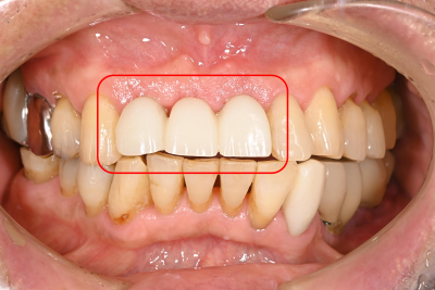 【症例】前歯のブリッジが何度も取れてしまう原因を突き止め、抜歯即時インプラント埋入治療で治療期間を短縮｜治療後|千葉県柏市の歯医者「ウィズ歯科クリニック」