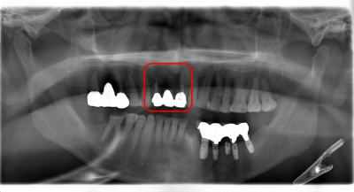 【症例】前歯のブリッジが何度も取れてしまう原因を突き止め、抜歯即時インプラント埋入治療で治療期間を短縮｜治療前のパノラマX線写真｜千葉県柏市の歯医者「ウィズ歯科クリニック」