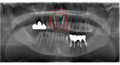 【症例】前歯のブリッジが何度も取れてしまう原因を突き止め、抜歯即時インプラント埋入治療で治療期間を短縮｜治療後のパノラマX線写真|千葉県柏市の歯医者「ウィズ歯科クリニック」