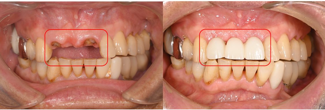 【症例】前歯のブリッジが何度も取れてしまう原因を突き止め、抜歯即時インプラント埋入治療で治療期間を短縮