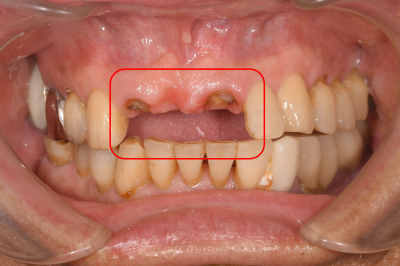 【症例】前歯のブリッジが何度も取れてしまう原因を突き止め、抜歯即時インプラント埋入治療で治療期間を短縮｜治療前|千葉県柏市の歯医者「ウィズ歯科クリニック」
