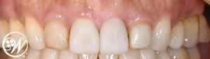 【症例】50代女性「10年以上前の被せ物をきれいに作り替えたい」見た目が不自然な前歯を、自然な白さの「ジルコニアクラウン」で美しく修復した症例