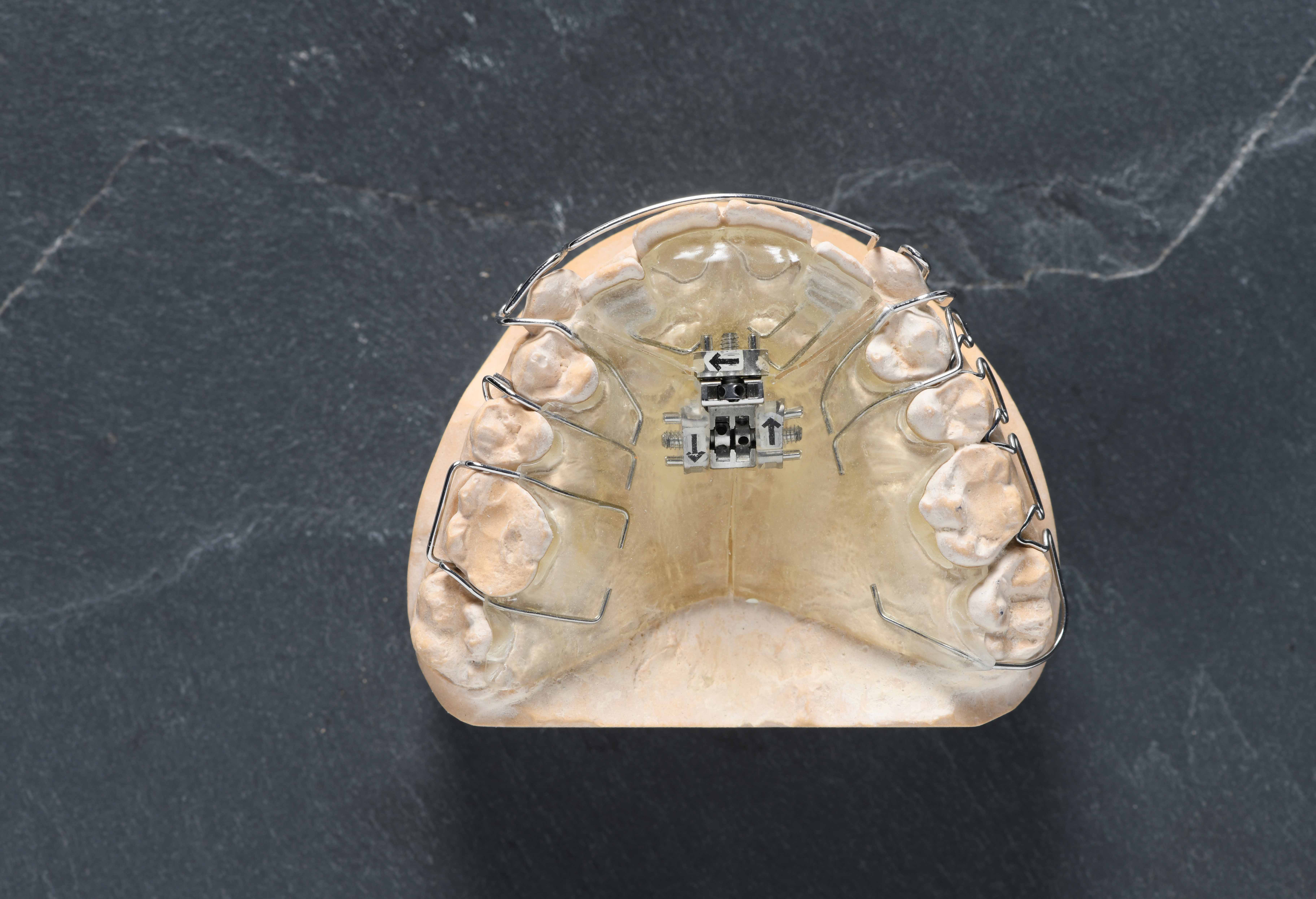 黒い台の上に矯正器具が付いた歯の模型が置かれている