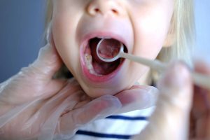 【小児の虫歯予防】サホライドとは？フッ素との違いや効果、治療の流れを解説！