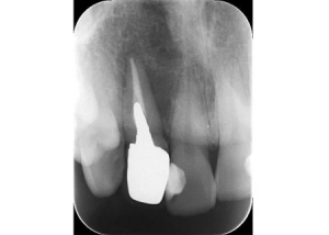 【症例】40代男性「差し歯の歯茎が腫れた」根っこが折れて細菌感染していた歯を抜いた後、骨の量を増やす手術と人工歯根を埋め込む「インプラント」で治療した症例