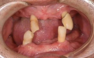 【症例】50代男性インプラントオーバーデンチャーとインプラントボーンアンカードブリッジにて治療した症例「残っている歯の状態が悪い。しっかり噛めるようになりたい」