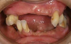 【症例】下顎オールオンフォーと上顎総義歯にて治療中の症例
