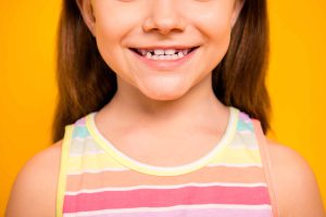 癒合歯・癒着歯とは？放置するリスクと治療の必要性を解説！