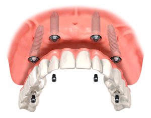オールオンフォーインプラントとは？メリットや治療の流れを解説！
