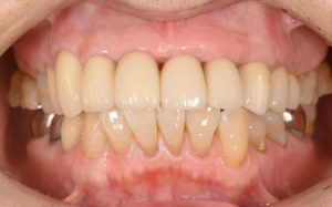 【症例】60代女性「前歯がぐらついて噛めない」人工の歯根「インプラント」と白くて強度のある「ジルコニアクラウン」による治療で、しっかり噛めて美しい口元へ改善した症例