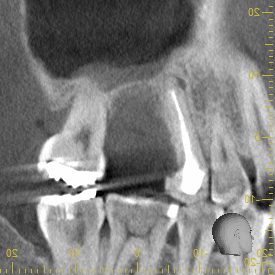 【症例】親知らずの移植をした歯が自然に抜けてしまった。その後、インプラント治療を見据えて骨増生を行った症例