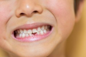 お子さまの永久歯が順調に生えてこない？「先天性欠如歯」とは