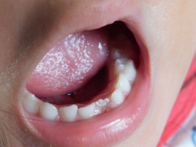 永久歯が生える順番と時期は？子どもの歯並びを守るための大切な知識