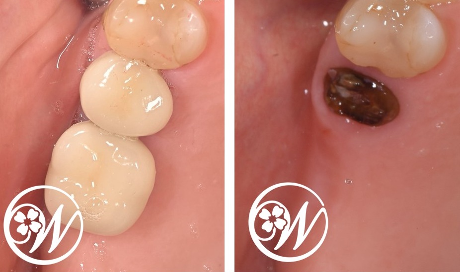 【症例】右上奥歯2本を低侵襲・短期間で回復｜抜歯即時インプラントとフラップレスインプラント症例