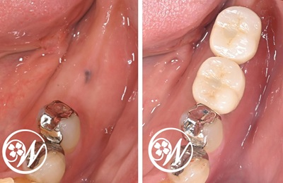 【症例】遠方からの通院も最小限に｜左下奥歯2本の低侵襲・短期間インプラント治療