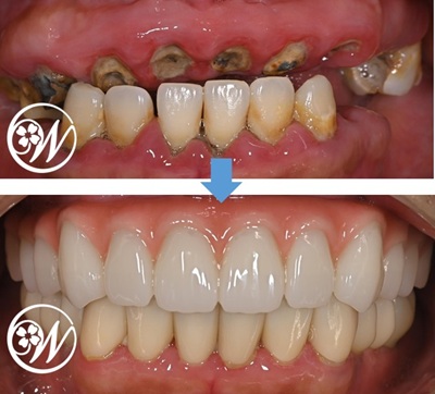 【症例】30代女性：痛くて外れる入れ歯から固定式の歯へ （上顎オールオン4＋下顎インプラントブリッジ）