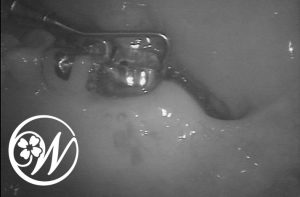 歯根破折が認められた写真