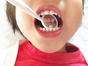 子どもの歯の形が気になる…よくある特徴と治療が必要なケース